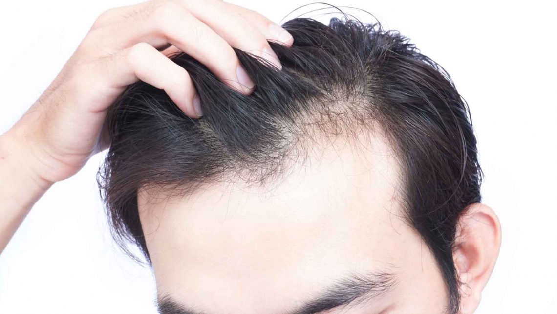 Causes Of Hair Loss