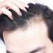 Causes Of Hair Loss